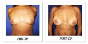 phoca_thumb_l_cohen-breast-augmentation-019