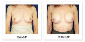 phoca_thumb_l_cohen-breast-augmentation-021