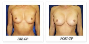phoca_thumb_l_cohen-breast-augmentation-025