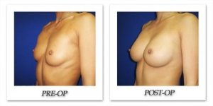 phoca_thumb_l_cohen-breast-augmentation-026