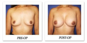phoca_thumb_l_cohen-breast-augmentation-032