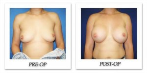 phoca_thumb_l_cohen-breast-augmentation-034