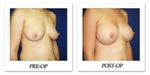 phoca_thumb_l_cohen-breast-augmentation-035