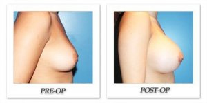 phoca_thumb_l_cohen-breastaugmentation-side