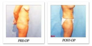 phoca_thumb_l_hodnett-liposuction-005