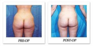 phoca_thumb_l_hodnett-liposuction-014