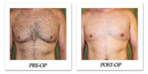 phoca_thumb_l_dr-begovic-male-breast-reduction-before-after-001