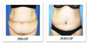 phoca_thumb_l_dr-begovic-tummy-tuck-before-after-004