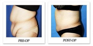 phoca_thumb_l_dr-begovic-tummy-tuck-before-after-005