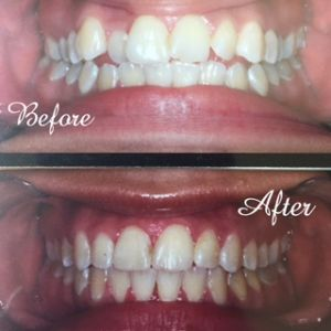 Top to Bottom before and after teeth treatment