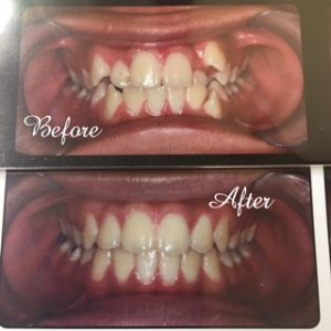 Top to Bottom before and after teeth treatment