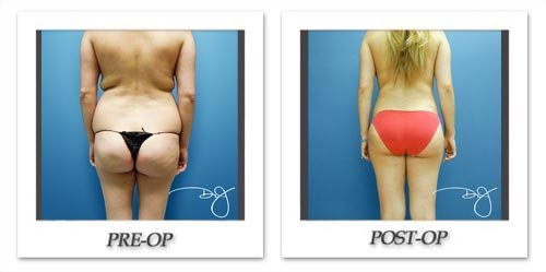 Study on Liposuction to Treat Lipedema Shows Why Lipo is A Leading Procedure